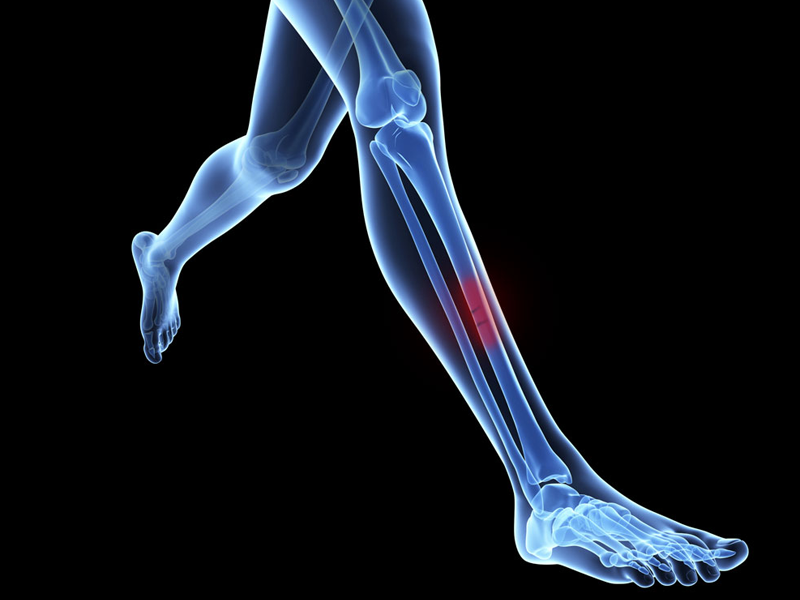 Ortopedia - OSTEOPOROSE