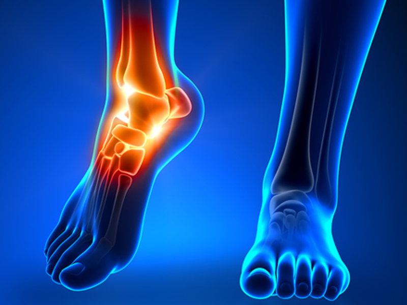 Ortopedia - PÉS - FASCIÍTE PLANTAR
